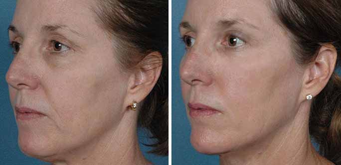 giovanna ringiovanta con filler cream giovanna ringiovanta con filler cream