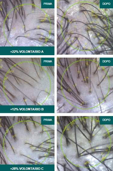 test clinici ricrescita capelli test clinici ricrescita capelli