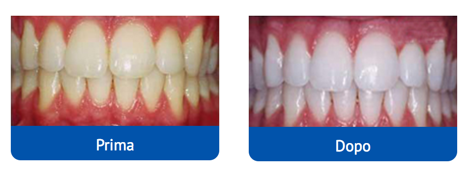 ionic white prima e dopo ionic white prima e dopo