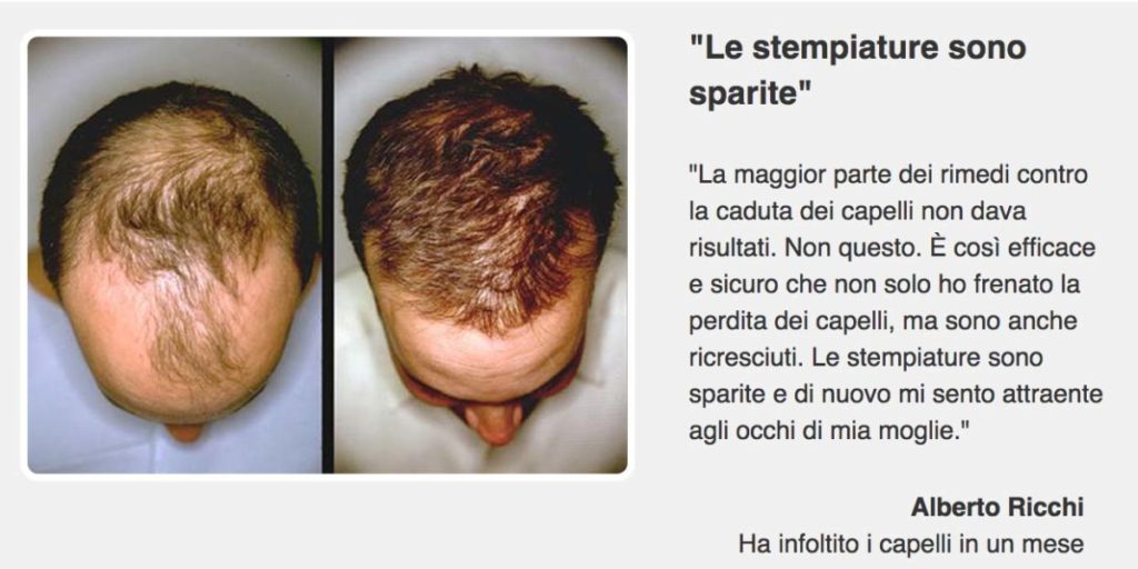 Roberto ha infoltito i capelli in un mese con Krestina Roberto ha infoltito i capelli in un mese con Krestina