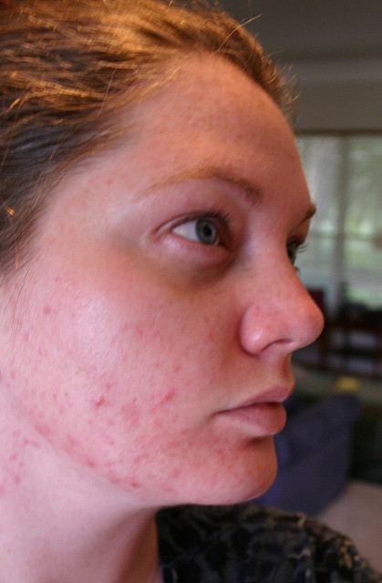 acne rosacea acne rosacea