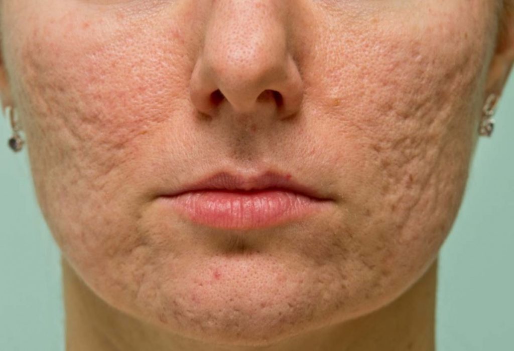 rimedi per acne da stress