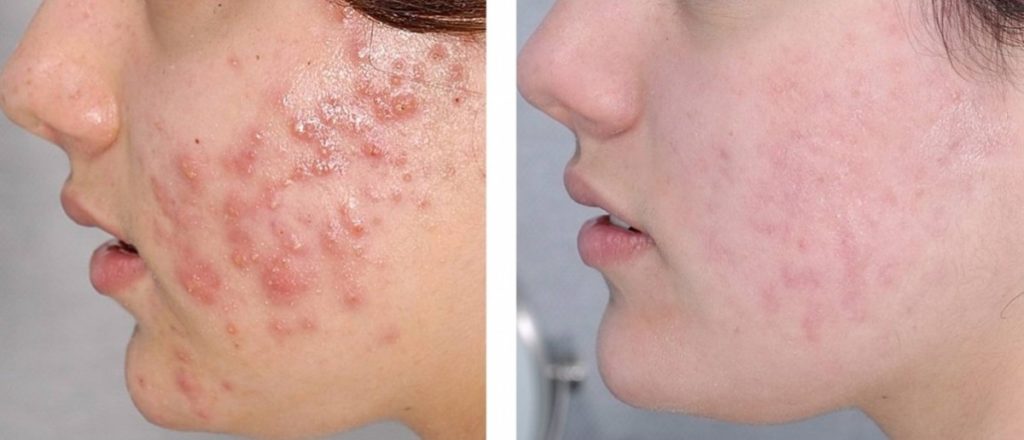 dove curare l'acne prima e dopo dove curare l'acne prima e dopo