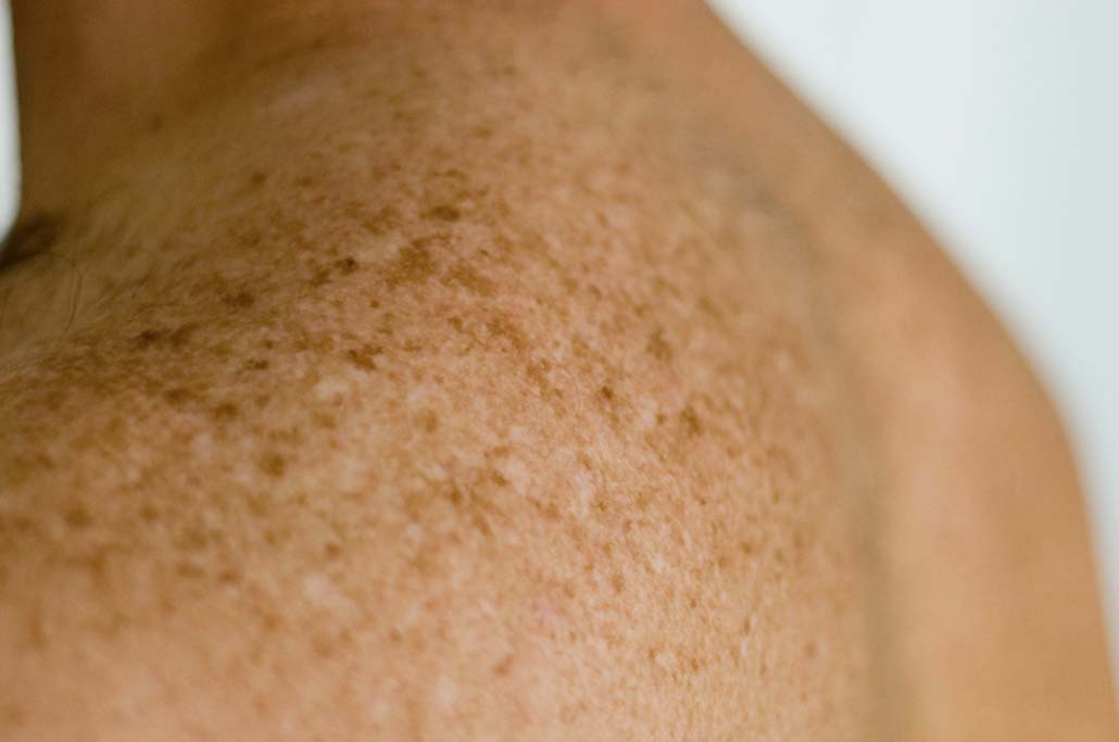 Comprare la crema yinni da posti di pigmentary