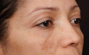macchie scure sulla pelle e iperpigmentazione