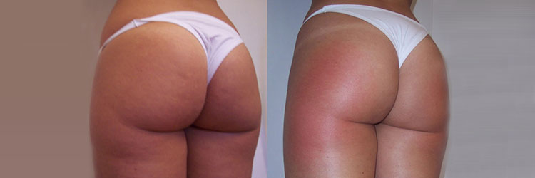 Prima e dopo trattamento effetti della crema anticellulite Baro