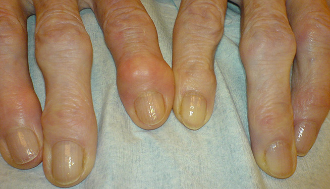 artrosi dita della mano artrosi dita della mano