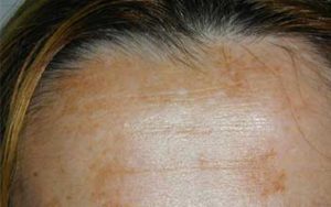 melasma della fronte