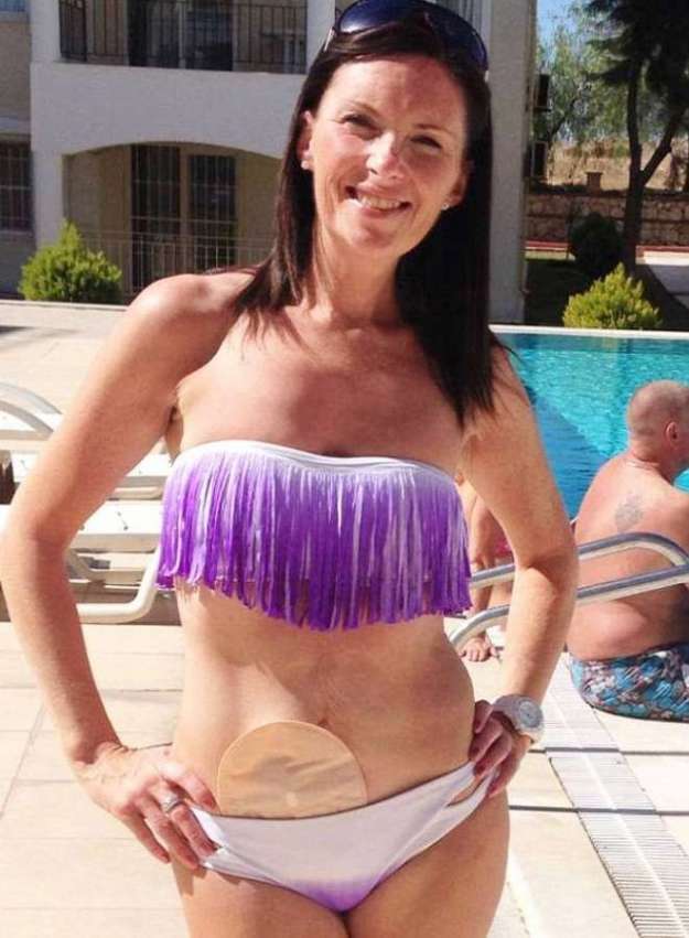 modella Bethany Townsend con colostomia Bethany Townsend colostomia