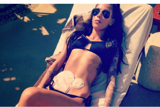 foto inbikini con stomia ragazza foto inbikini con stomia ragazza