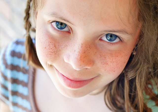 bambina con discromie bambina con discromie