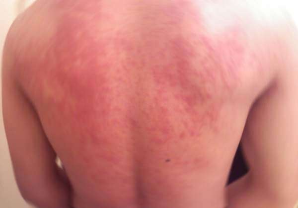 discromie rosse pelle discromie rosse pelle