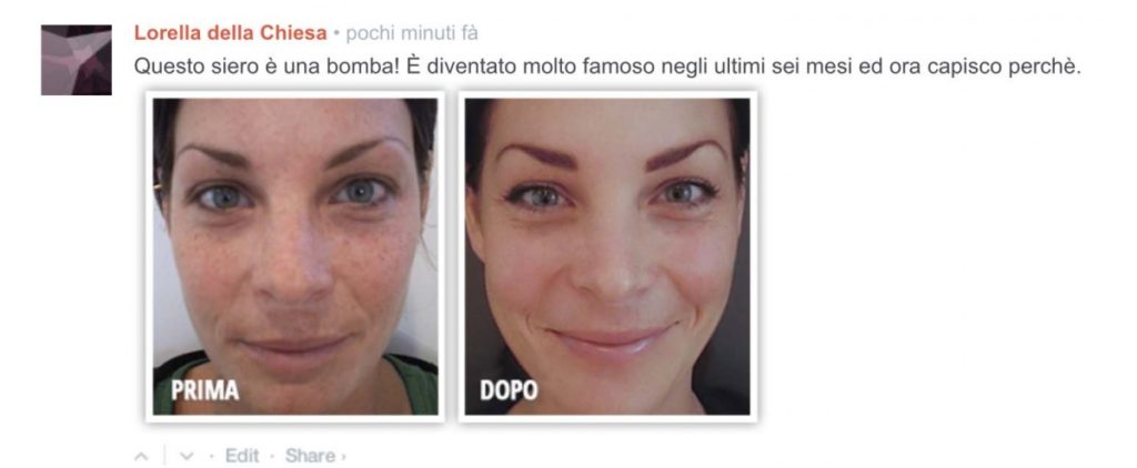 Lorella mostra i risultati prima e dopo I risultati antirughe del veleno d'ape