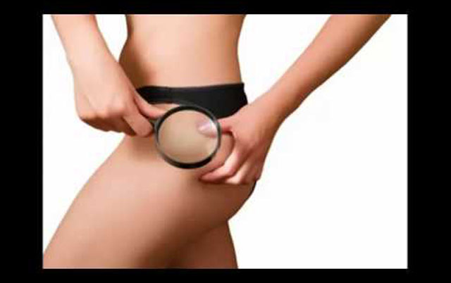 Cellulite rimedi naturali