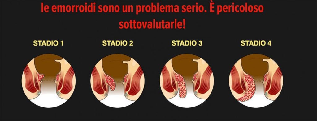 Stadi delle emorroidi Stadi delle emorroidi