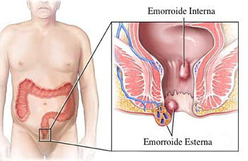 emorroidi nello specifico emorroidi interne ed esterne