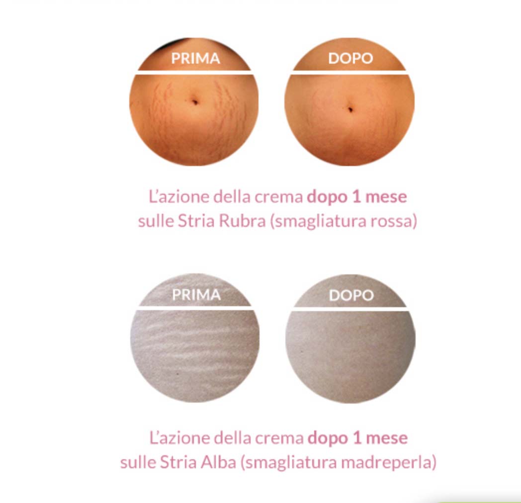 effetti prima e dopo prima e dopo le jeune smagliature