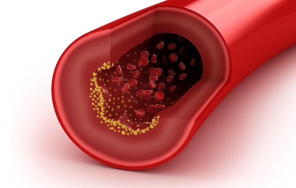 Il colesterolo cattivo ostruzione Ostruzione arterie colesterolo