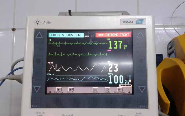 rilevamento tachicardia