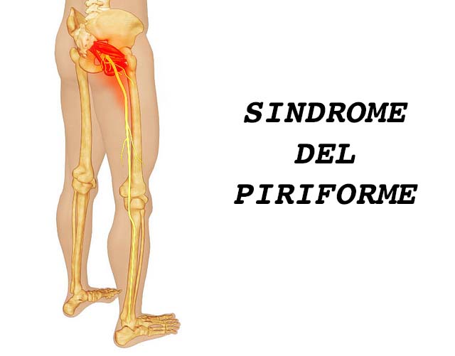 la sindrome del piriforme