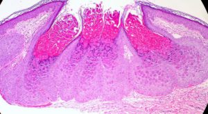 mollusco contagiosum al microscopio