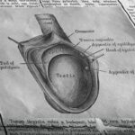 varicocele